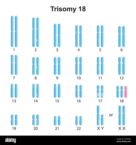 Extra chromosome 18 Cut Out Stock Images & Pictures - Alamy