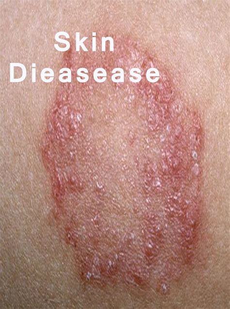 All skin diseases APK for Android Download