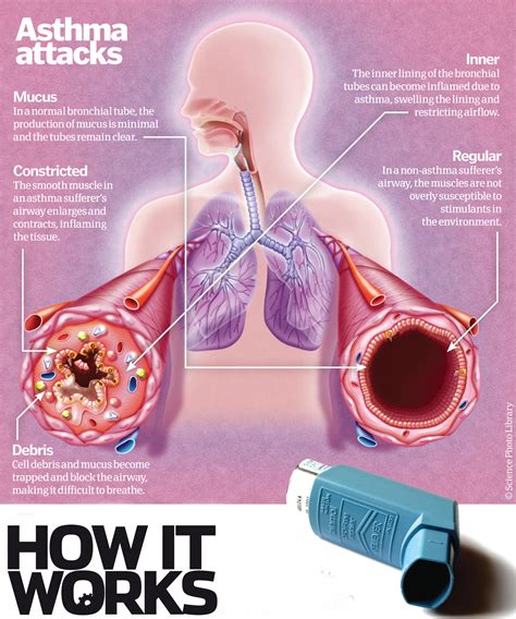 Why does asthma make it difficult to breathe? | How It Works Magazine