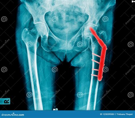 X-ray hip replacement stock photo. Image of bone, inflammation - 123039508