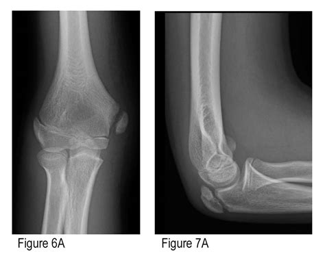 How to Avoid Missing a Pediatric Elbow Fracture - ACEP Now