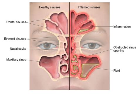 Sinus Infection (Sinusitis) | Community | Antibiotic Use | CDC