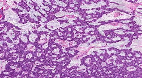 Invasive mucinous carcinoma of the breast - MyPathologyReport.ca