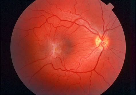 Epiretinal Membrane — East Point Vision