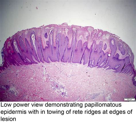 Verruca Plana Histology