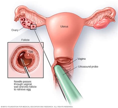 IVF in Iran | In-Vitro Fertilization Treatment | AriaMedTour