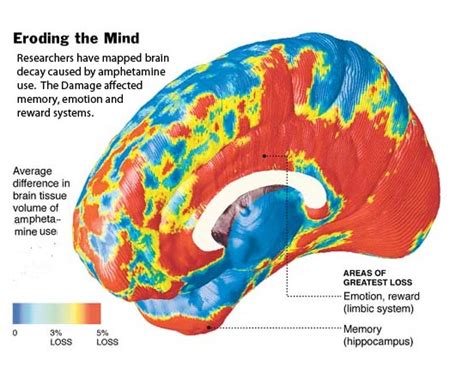 ADHD Drugs, Amphetamines and Brain Damage