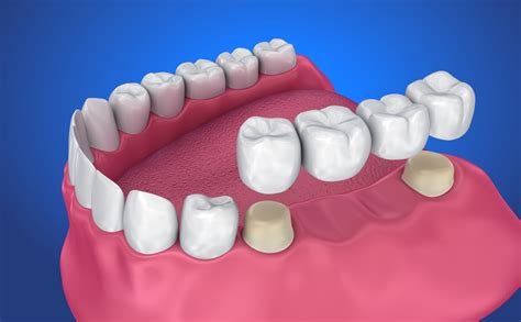 How to Take Care of a Removable Dental Bridge