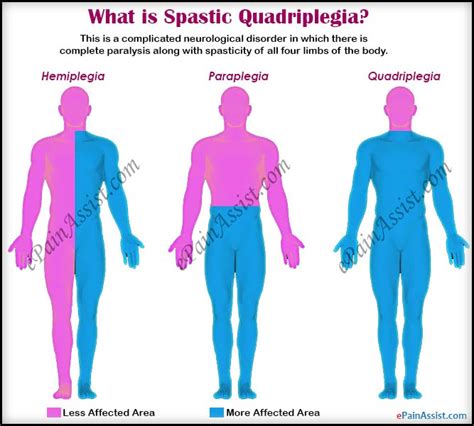 Spastic Quadriplegia: Treatment, Complications, Symptoms, Causes