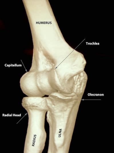 Radial head fracture - ElbowDoc