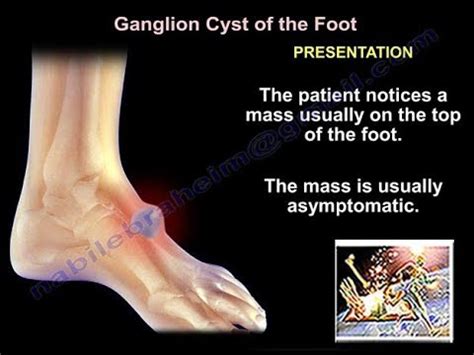 Ganglion Cyst On A Foot Knitting Pattern