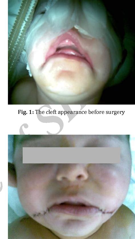 [PDF] Treatment of Bilateral Macrostomia (Lateral Lip Cleft): Case Report | Semantic Scholar