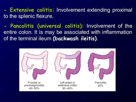 Ulcerative colitis