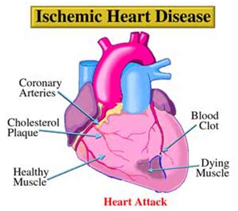 Ischemic Heart Disease