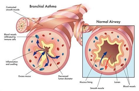 Bronchitis And Asthma: Understanding The Connection - Ask The Nurse Expert