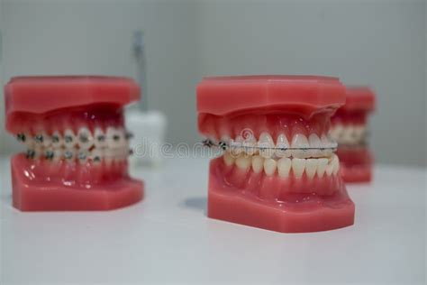 Samples of Dentures with Porcelain Teeth and Dental Device on a White ...