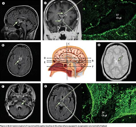 Figure 3 from The spectrum of neuromyelitis optica | Semantic Scholar