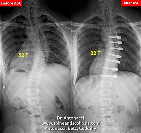 RS 14 Scoliosis Single Curve from 52 Thoracic - Institute for Spine and ...