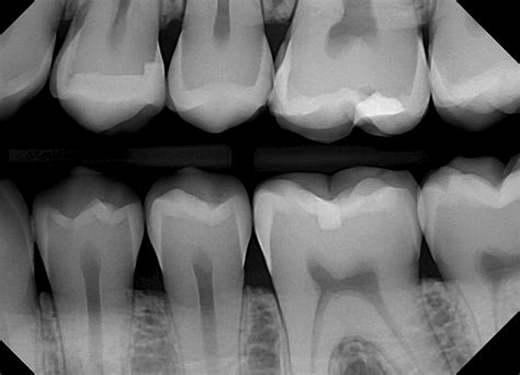 Bitewing X-rays – Dentistry.com