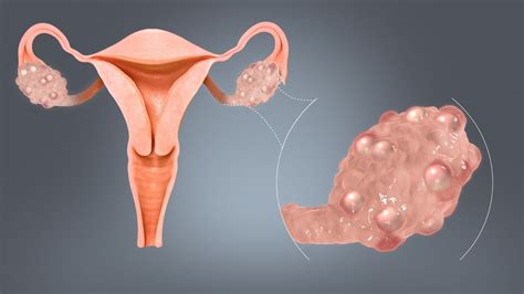 Polycystic Ovary Syndrome (PCOS): Signs, Symptoms, Causes, and ...