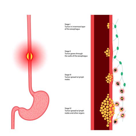 Oesophageal Cancer in Singapore - Alpha Digestive & Liver Centre