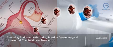 A prediction model to identify endometriosis during routine ultrasound . | EndoNews