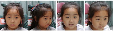 Case 7. (A, B) At 5 years of age 30Δ alternating exotropia was noted ...