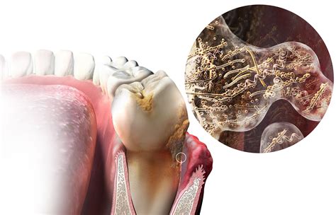 Plaque Formation on Teeth - Portfolio - SayoStudio