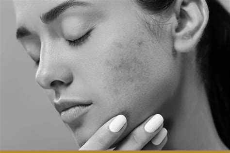 Hormonal Imbalance Acne: Causes and Treatments