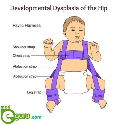 Developmental Dysplasia Of The Hip Causes Symptoms Diagnosis | Hot Sex Picture