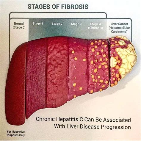 Liver Injury and Obesity - DSSurgery