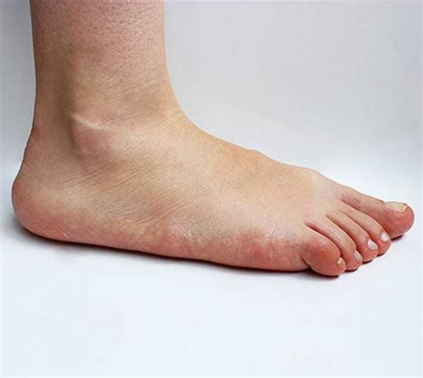 Surgical Flat Foot Correction - Burbank Podiatrist | Los Angeles Foot & Ankle Center