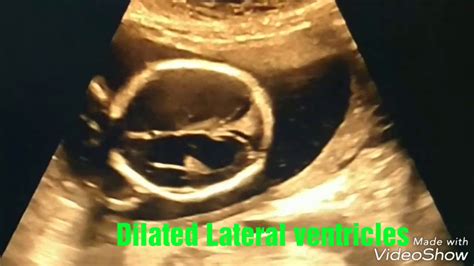 Hydrocephalus on ultrasound in 19 wk Pregnancy - YouTube