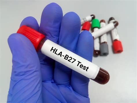 HLA B27 Test in Hindi