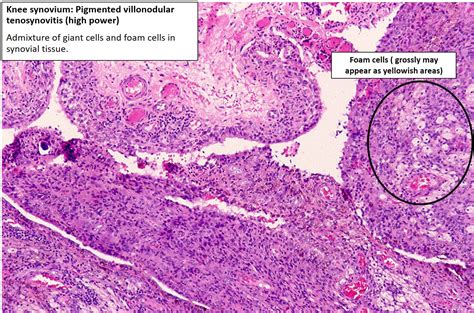 Knee – Villonodular synovitis (knee)/Tenosynovial giant cell tumour (03502) – NUS Pathweb :: NUS ...