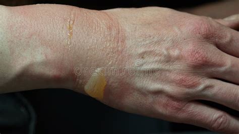 Close-up of a Woman S Hand with a Blister from a Boiled Water Burn ...