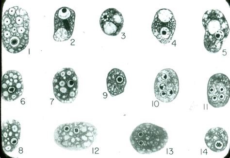 Dientamoeba fragilis Infection