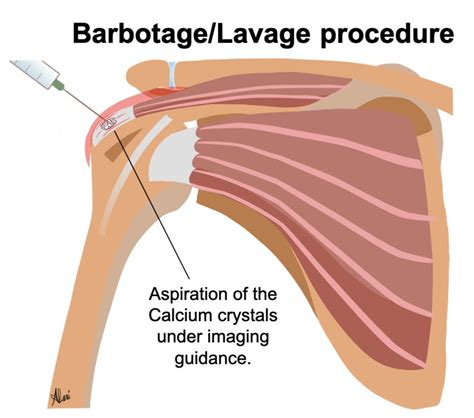 Ultrasound-Guided Shoulder Barbotage for Calcific Tendonitis