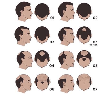 The Norwood Scale - Where Do You Position? NW2 NW3 NW1