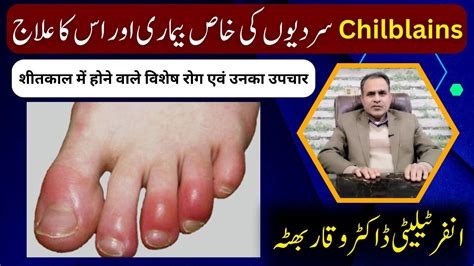 Chilblains: Causes, Symptoms, and Homeopathic Treatments by Dr Waqar ...