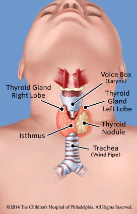 Thyroid Nodules | Children's Hospital of Philadelphia