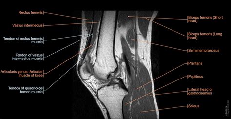 Knee Anatomy Mri