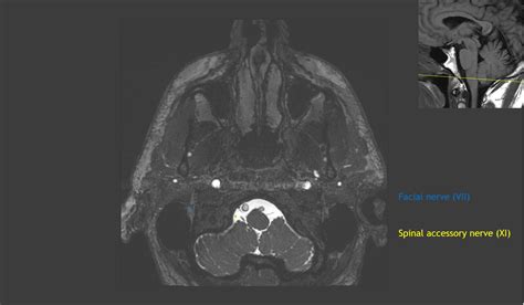 CaseStacks.com - Cranial Nerve Anatomy on MRI