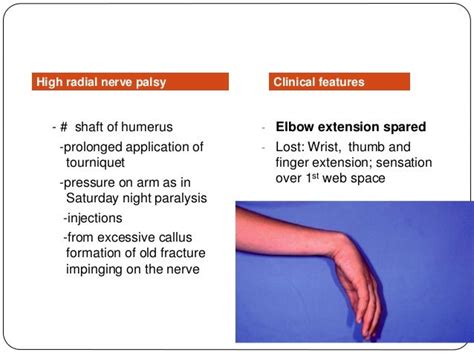 Radial Nerve Palsy