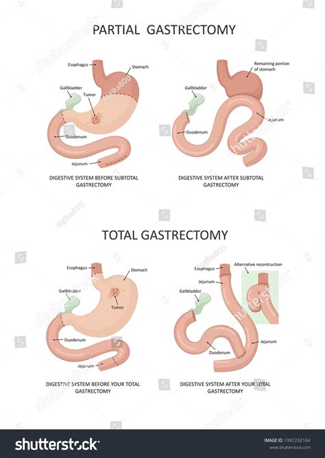 Partial Gastrectomy