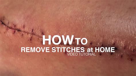 How to remove stitches at home - YouTube