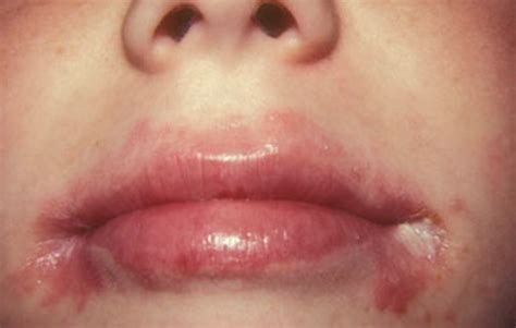 Angular Cheilitis - Pictures, Symptoms, Contagious, Treatment - (2018 - Updated)