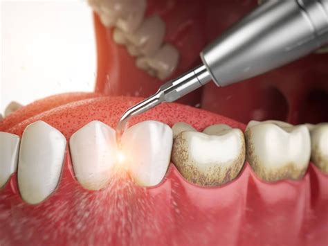 Periodontal Scaling & Root Planing | Pioneer Dental Center