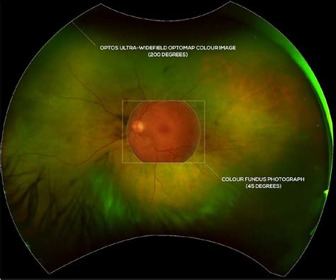 Comparison of optos ultra-widefield imaging (200 degrees field of view)... | Download Scientific ...