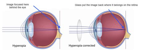 Hyperopia & Long Sightedness Explanation - Melbourne Eye Centre